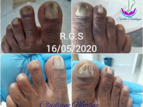 A onicomicose É uma infecção causada por fungos que se alimentam da queratina, proteína que forma a maior parte das unhas.  A micose pode levar a unha a adquirir um aspecto grosso, chamado popularmente de “unha de telha” ou “unha de gavião”.  O tratamento é realizado mensalmente no consultório podológico e diariamente em casa, o trabalho conjunto e a  persistência é fundamental para o sucesso.
