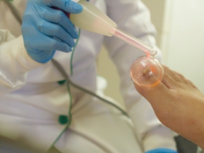 Tratamento de Onicomicose ( micose ou fungo) nas unhas com finalização de aplicação de alta frequência. A alta frequência nesse tipo de tratamento o ozônio gerado possui efeito fungicida e bactericida, estimulando a circulação do local onde é aplicada e, sua função vasodilatadora e hiperemiante facilita a penetração de medicamentos sistêmicos.