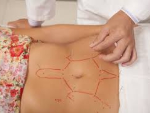 Acupuntura para obesidade