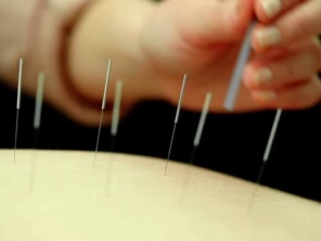 Acupuntura para dores nas costas