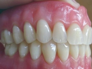 Materiais de alta qualidade tornando o seu sorriso o mais perto do natural com dentes e gengivas caracterizadas