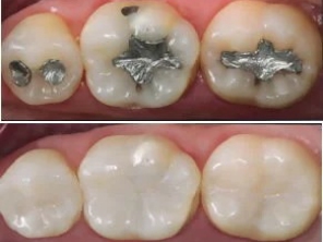 Restaurações de resina composta na cor do seu dente!