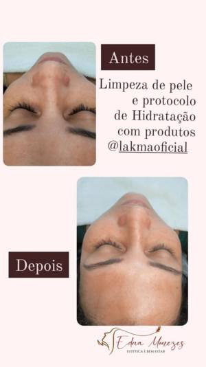 Antes e depois Limpeza de pele