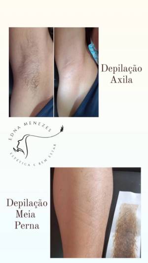 D (Epilção) Feminina