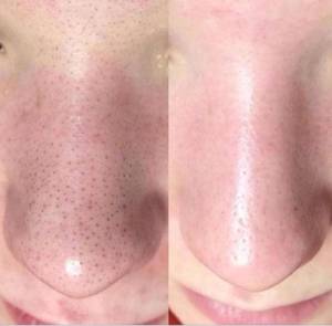 Antes e depois de Limpeza de pele