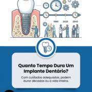 Quanto Tempo Dura Um Implante Dentário?