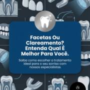 Facetas Ou Clareamento? Entenda Qual É Melhor Para Você
