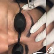 Remoção a Laser de tatuagem e micropigmentação