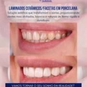 Facetas de porcelana