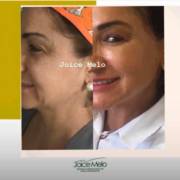 Preenchimento facial!