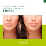 Um bom preenchimento labial pode fazer toda a diferença!