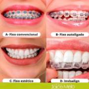 Conheça os variados tipos de aparelhos fixos!