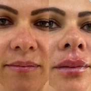 Realce sua Beleza com Preenchimento Labial Natural na Clínica Joice Melo
