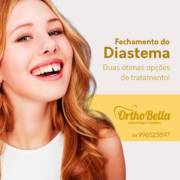 Fechamento do Diastema