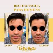 Bichectomia para o Homem