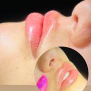 Procedimento Labial