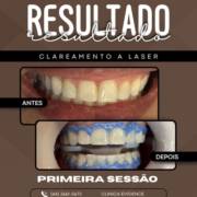 Clareamento a laser: tecnologia para seu melhor sorriso