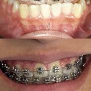 Tratamento com aparelhos ortodônticos na Evidence Odontologia e Estética em Mineiros