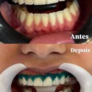 Um sorriso mais branco e iluminado começa com o cuidado certo!