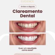 Seu sorriso ainda mais belo! Conheça o Clareamento Dental de Evidence em Mineiros