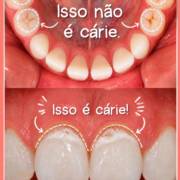 Será que é cárie? Uma boa avaliação faz a diferença!