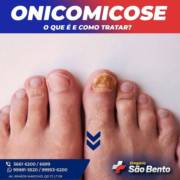 Onicomicose, o que é e como tratar?