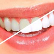 Clareamento Dental