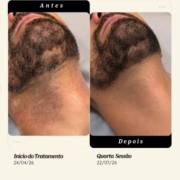 Barba no laser: mais praticidade para o seu dia a dia