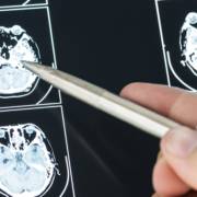 5 sinais de que é hora de visitar um Neurologista