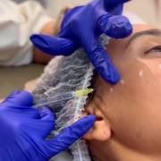 Quais os benefícios do botox para o rosto?