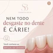 Nem Todo Desgaste nos Dentes é Cárie!!