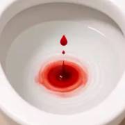 Hematúria: quando o sangue na urina é sinal de alerta?