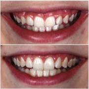 Gengivoplastia: pequenos ajustes que transformam a harmonia do sorriso
