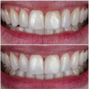 Profilaxia Master AirFlow: Limpeza Profunda e Renovação para o Seu Sorriso