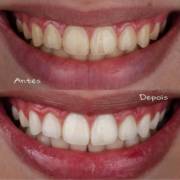 Seu novo sorriso começa com um clareamento dental