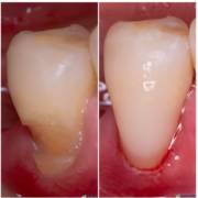 Restauração cervical: mais proteção, conforto e estética para o seu sorriso