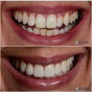 Ortodontia e facetas em resina: um sorriso planejado em cada etapa