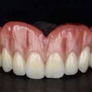 Prótese Total Personalizada para um Sorriso Natural
