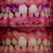 Evidenciador de placa e profilaxia para uma melhor prevenção