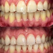 Profilaxia profissional: cuidado, prevenção e saúde bucal