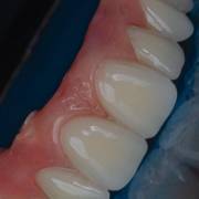 Protocolo sobre implantes: precisão, função e harmonia
