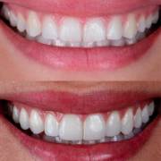 Facetas que valorizam a beleza natural do sorriso