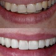 Ortodontia e facetas para um sorriso mais harmônico