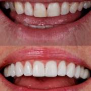 Transformação do sorriso com facetas em porcelana
