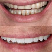 Reabilitação do sorriso com prótese total
