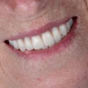 Um novo sorriso pode transformar não apenas a aparência, mas também o conforto e a qualidade de vida