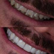 Laminados cerâmicos: um novo sorriso começa muito antes do resultado final