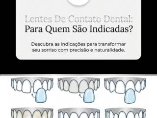 Lentes De Contato Dental: Para Quem São Indicadas?