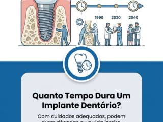 Quanto Tempo Dura Um Implante Dentário?