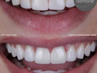 O que é melhor faceta ou lente de contato?